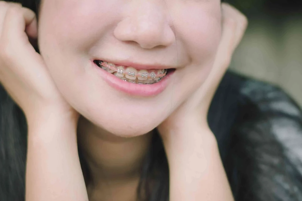 Happy smile of young woman after getting Invisalign treatment